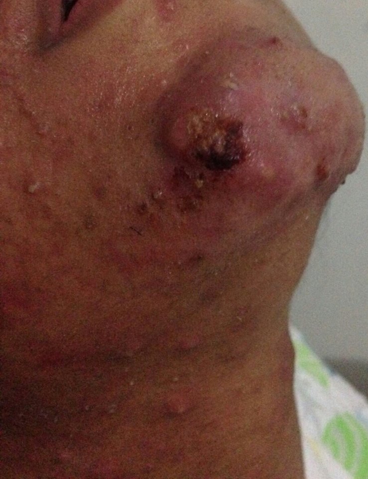 Before treatment